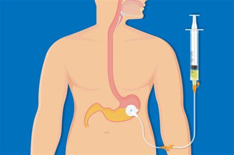 Percutaneous endoscopic gastrostomy